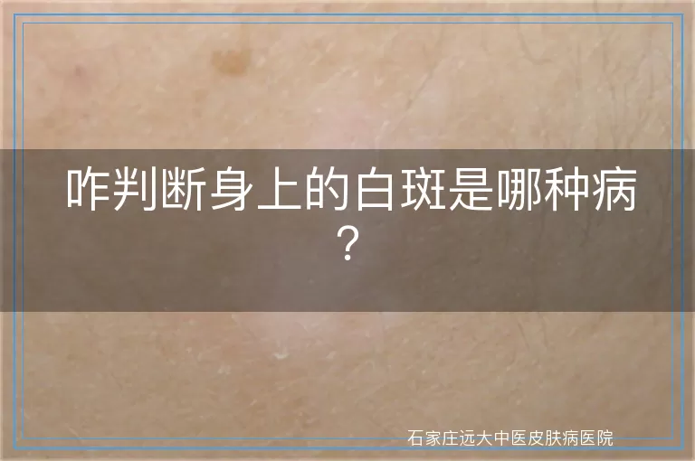 咋判断身上的白斑是哪种病？