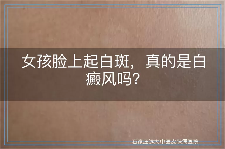女孩脸上起白斑，真的是白癜风吗？