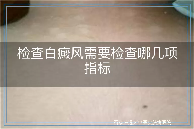 检查白癜风需要检查哪几项指标