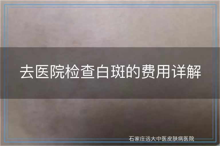 去医院检查白斑的费用详解