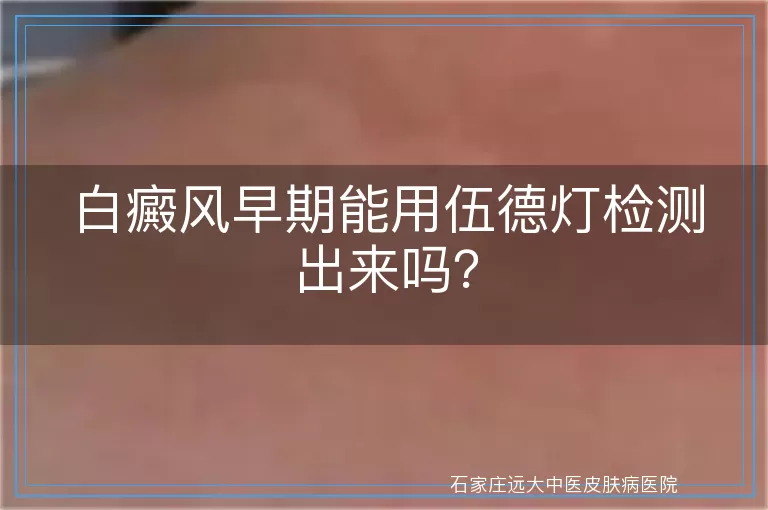 白癜风早期能用伍德灯检测出来吗？