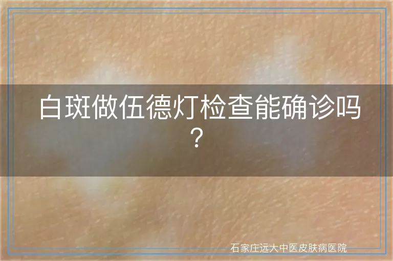 白斑做伍德灯检查能确诊吗？