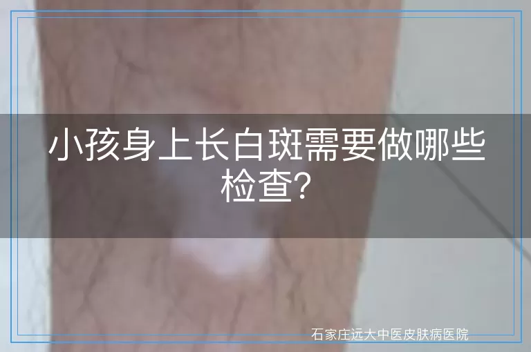 小孩身上长白斑需要做哪些检查？