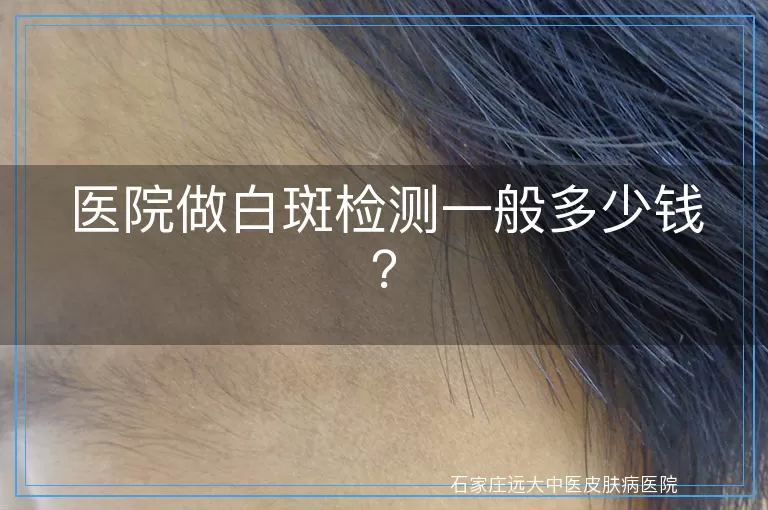 医院做白斑检测一般多少钱?