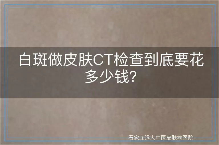 白斑做皮肤CT检查到底要花多少钱？