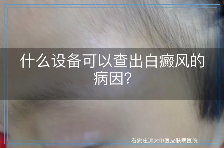 什么设备可以查出白癜风的病因？