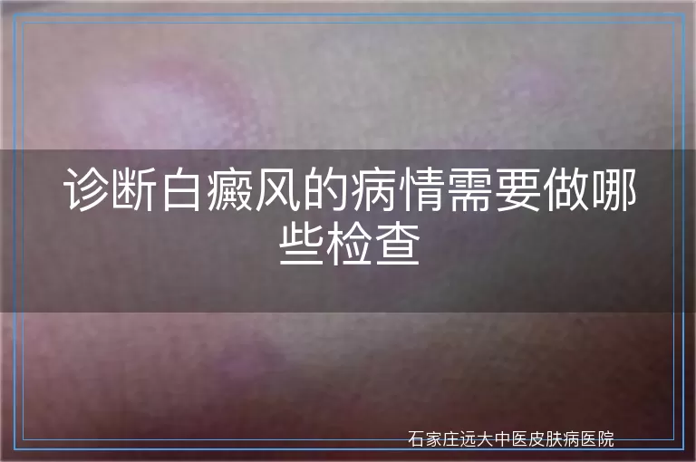 诊断白癜风的病情需要做哪些检查
