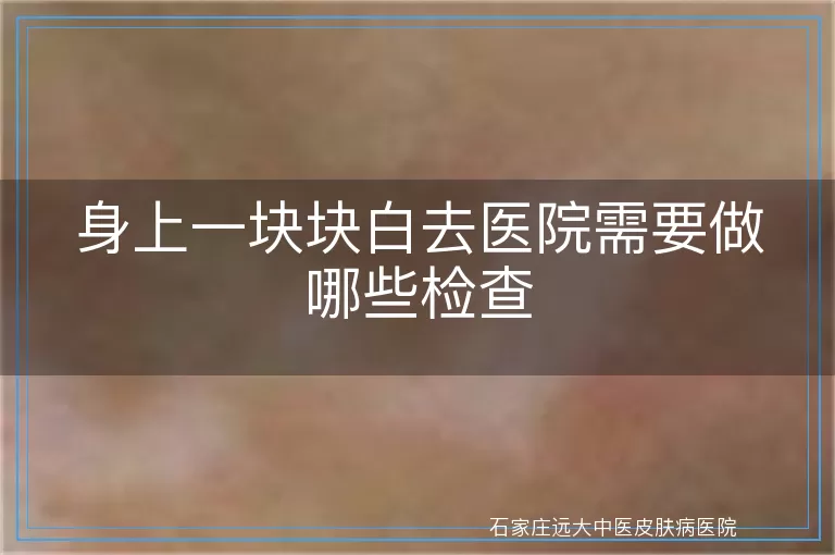 身上一块块白去医院需要做哪些检查