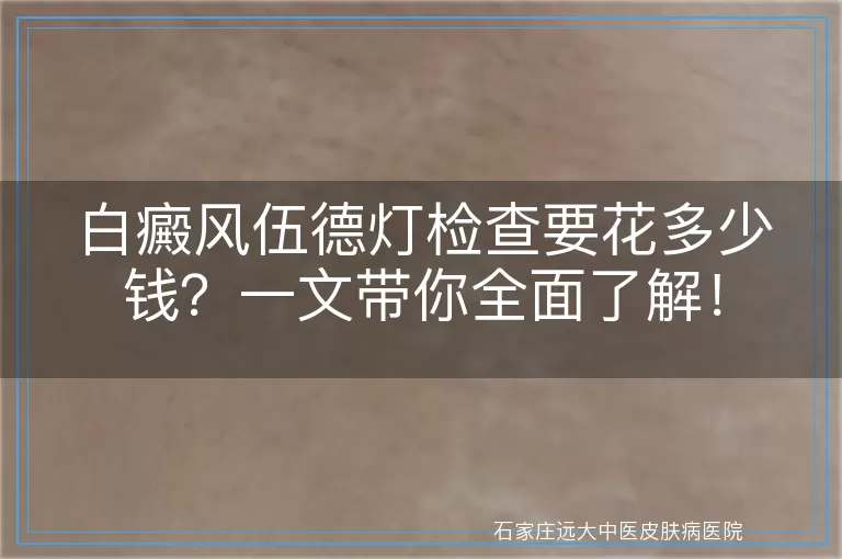 白癜风伍德灯检查要花多少钱？一文带你全面了解！