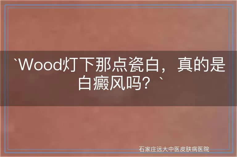 Wood灯下那点瓷白，真的是白癜风吗？