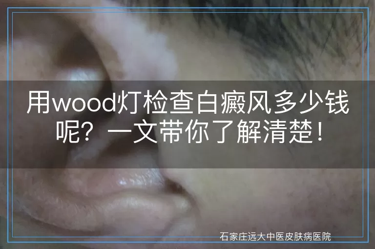 用wood灯检查白癜风多少钱呢？一文带你了解清楚！