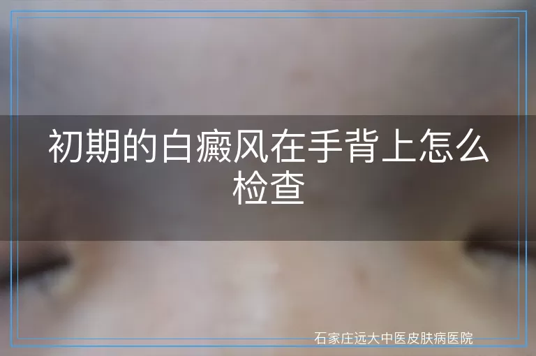 初期的白癜风在手背上怎么检查