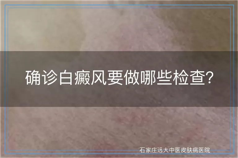 确诊白癜风要做哪些检查？