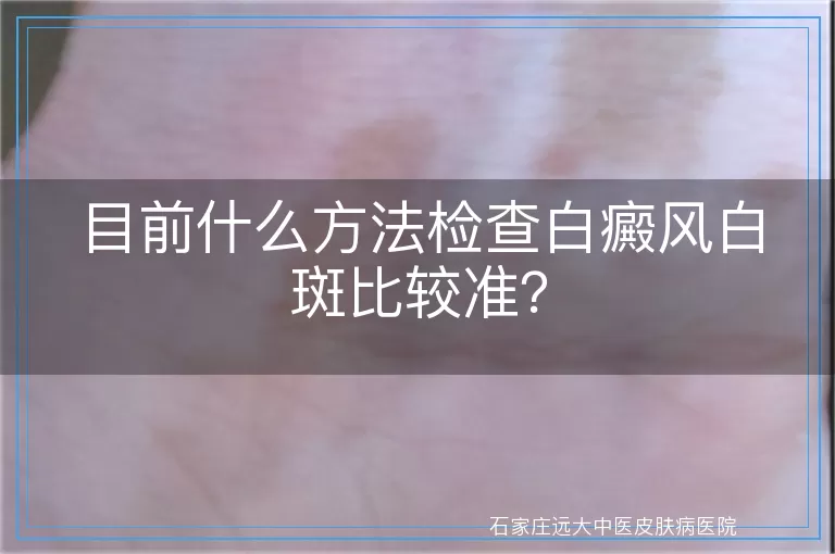 目前什么方法检查白癜风白斑比较准？