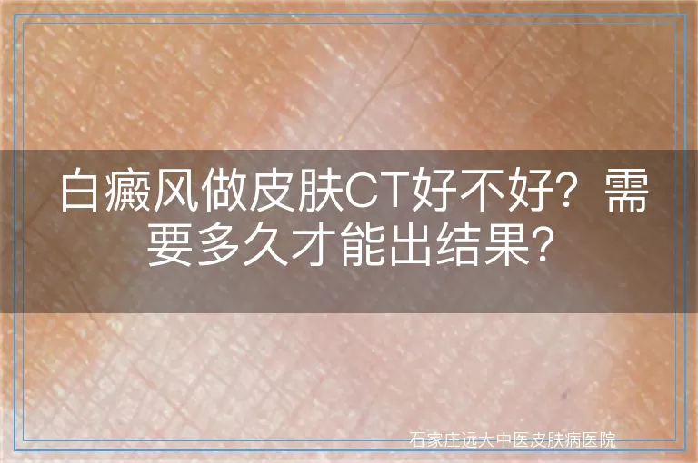 白癜风做皮肤CT好不好？需要多久才能出结果？