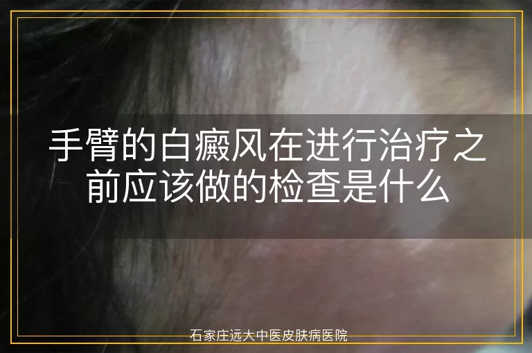 手臂的白癜风在进行治疗之前应该做的检查是什么