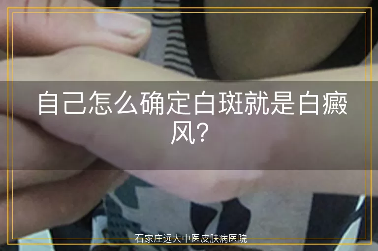 自己怎么确定白斑就是白癜风？