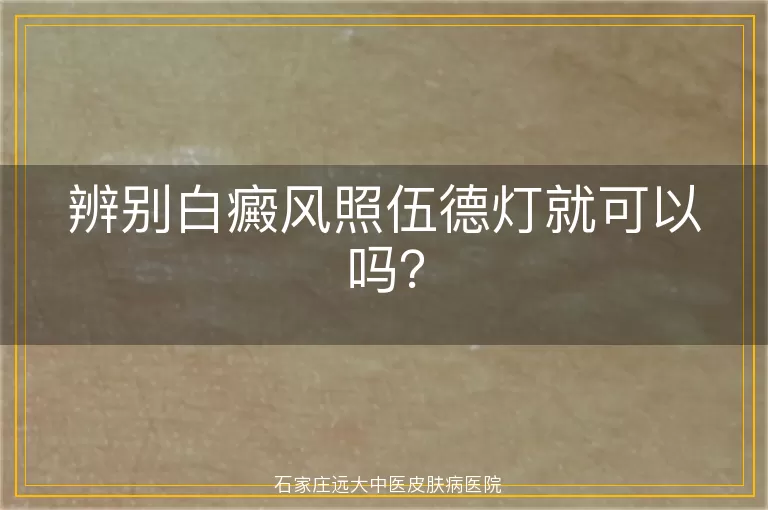 辨别白癜风照伍德灯就可以吗？