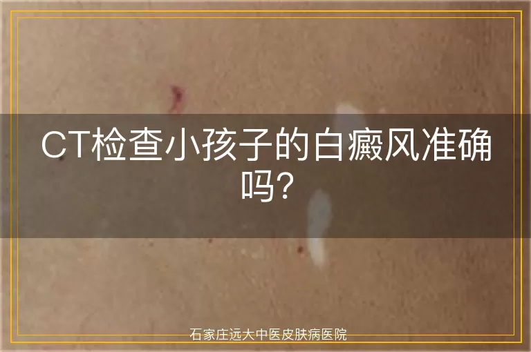 CT检查小孩子的白癜风准确吗？