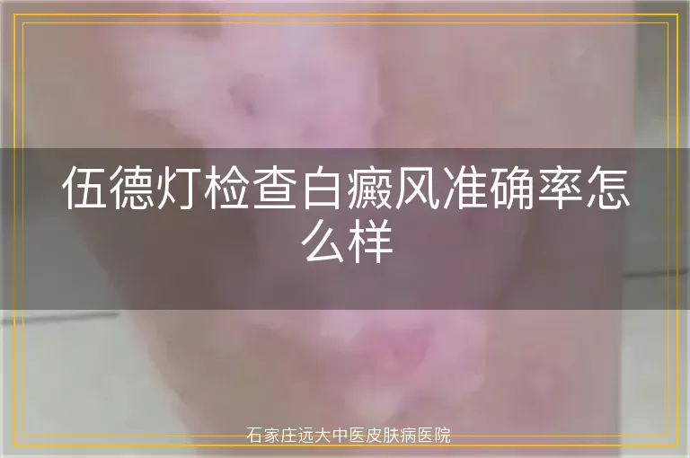 伍德灯检查白癜风准确率怎么样