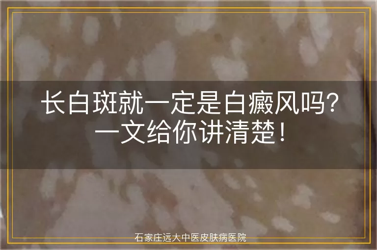 长白斑就一定是白癜风吗？一文给你讲清楚！