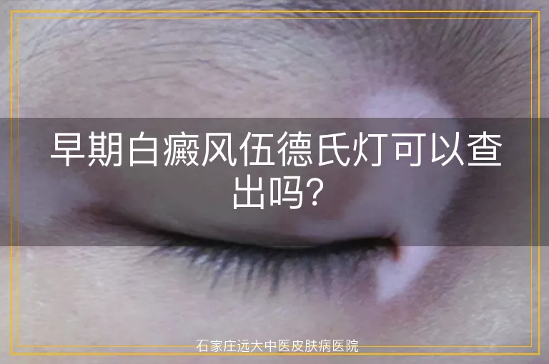早期白癜风伍德氏灯可以查出吗？
