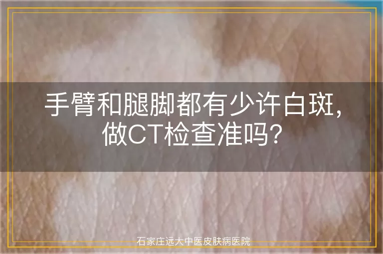 手臂和腿脚都有少许白斑，做CT检查准吗？