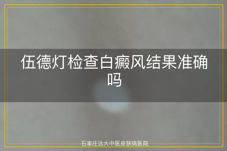 伍德灯检查白癜风结果准确吗