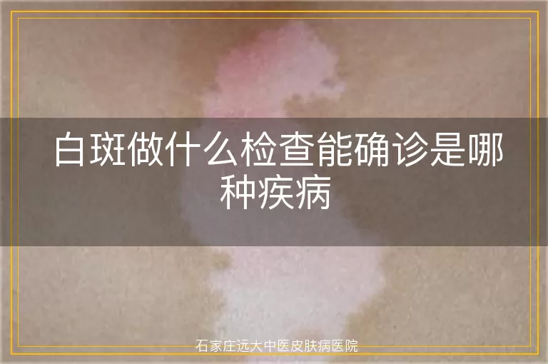 白斑做什么检查能确诊是哪种疾病