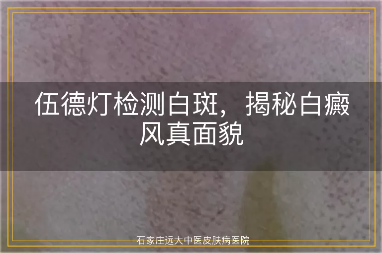 伍德灯检测白斑，揭秘白癜风真面貌
