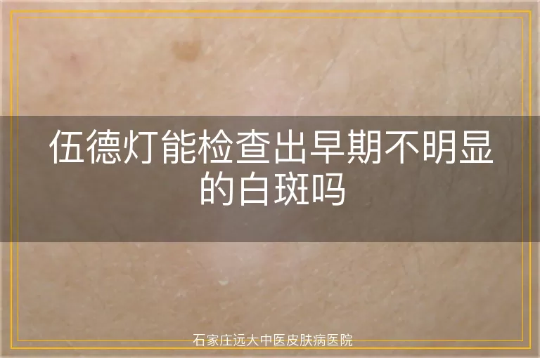 伍德灯能检查出早期不明显的白斑吗