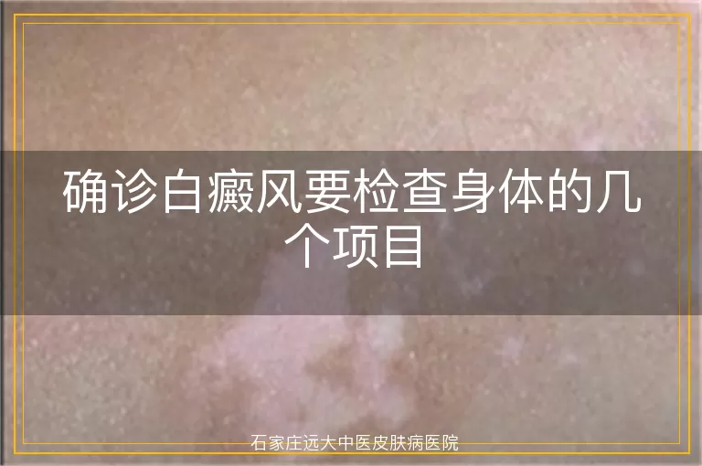 确诊白癜风要检查身体的几个项目