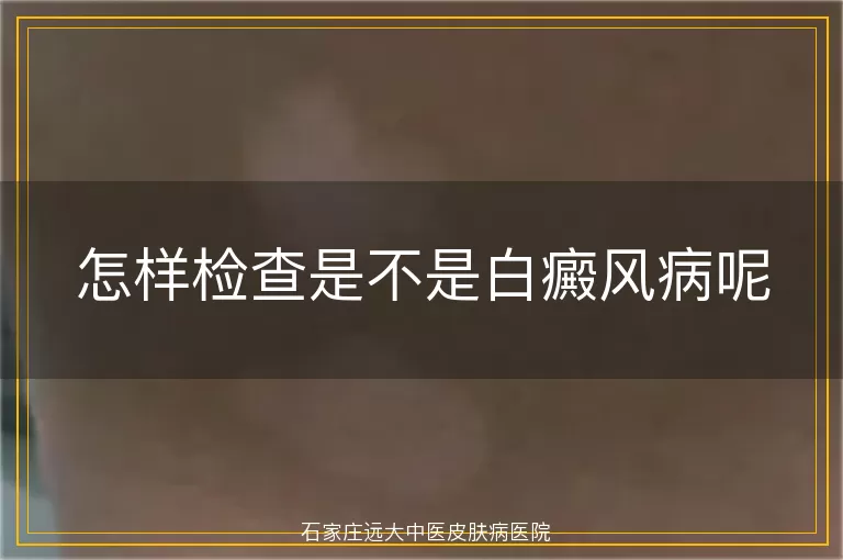 怎样检查是不是白癜风病呢