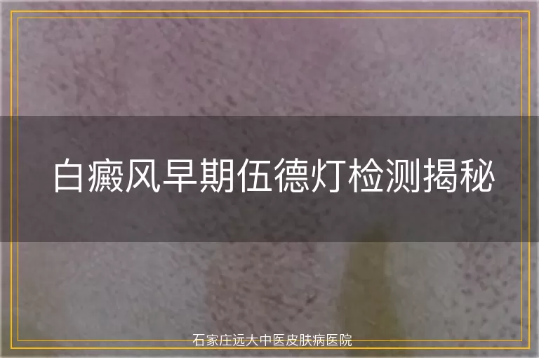 白癜风早期伍德灯检测揭秘