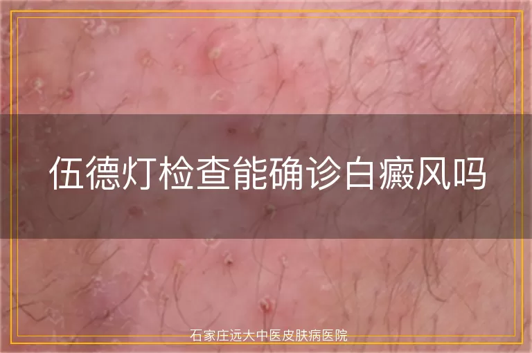 伍德灯检查能确诊白癜风吗