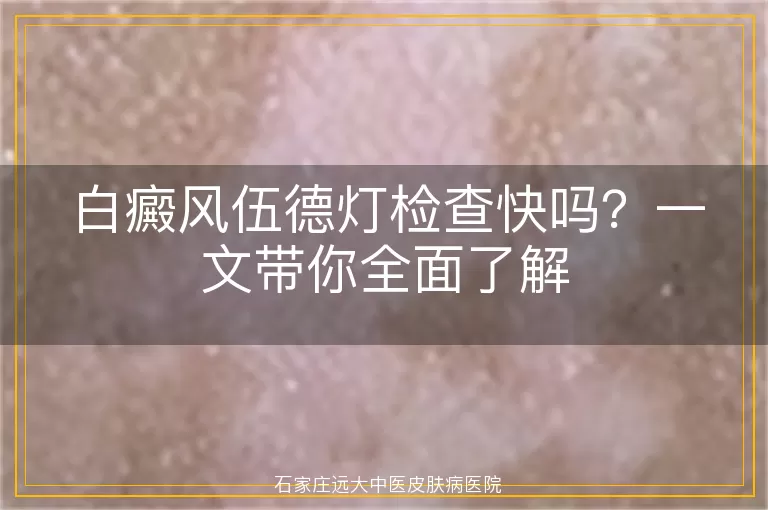 白癜风伍德灯检查快吗?一文带你全面了解