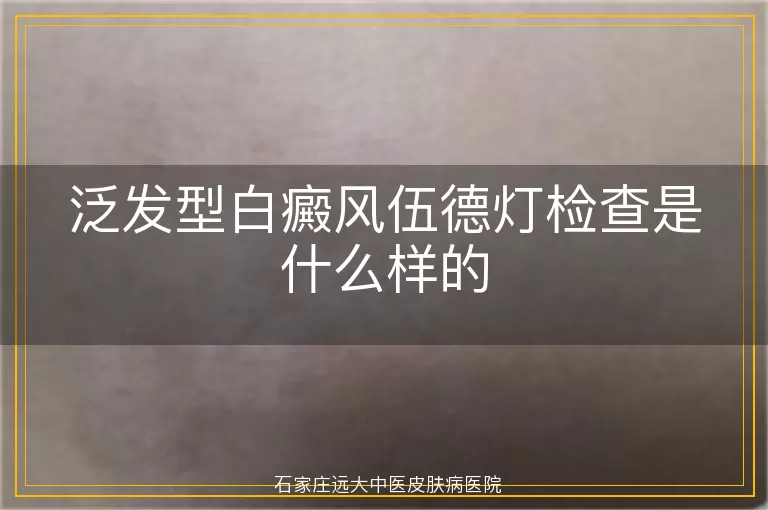 泛发型白癜风伍德灯检查是什么样的
