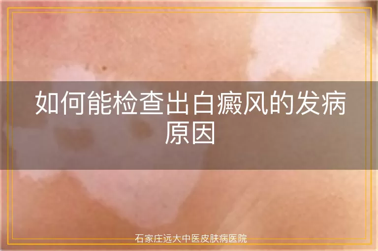 如何能检查出白癜风的发病原因