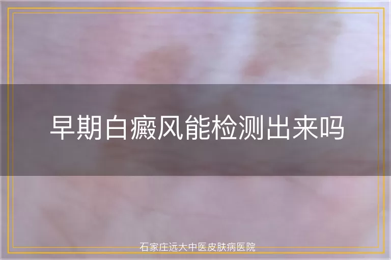 早期白癜风能检测出来吗