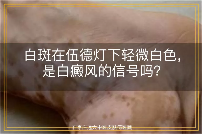 白斑在伍德灯下轻微白色，是白癜风的信号吗？
