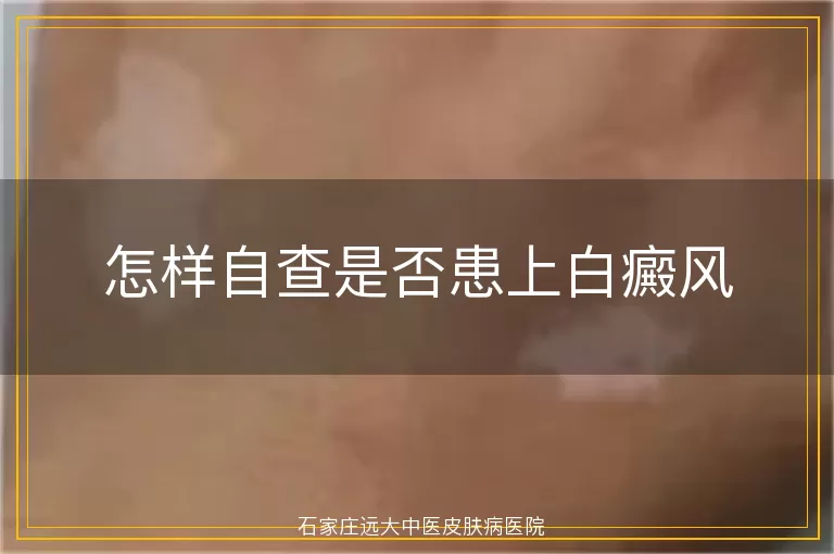 怎样自查是否患上白癜风
