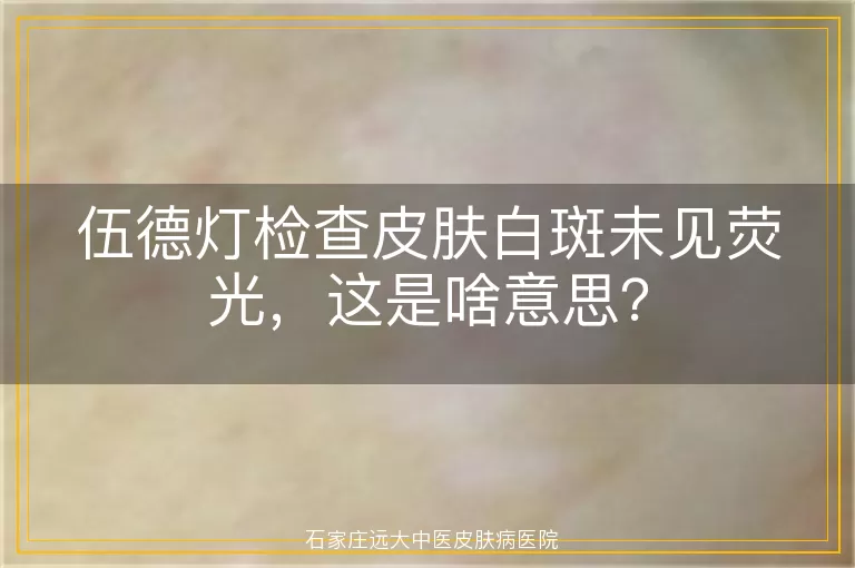 伍德灯检查皮肤白斑未见荧光，这是啥意思？