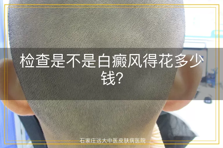 检查是不是白癜风得花多少钱?
