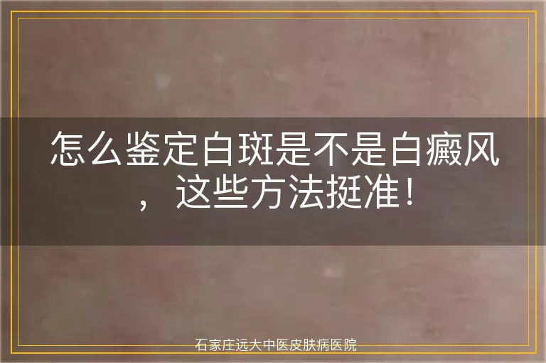 怎么鉴定白斑是不是白癜风，这些方法挺准！