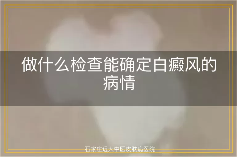 做什么检查能确定白癜风的病情