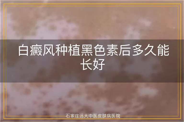 白癜风种植黑色素后多久能长好