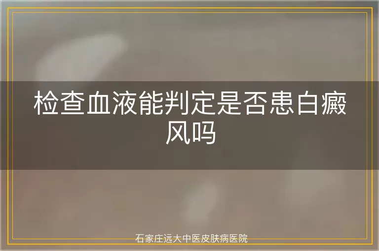 检查血液能判定是否患白癜风吗
