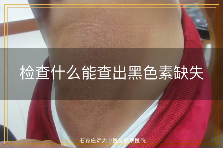 检查什么能查出黑色素缺失