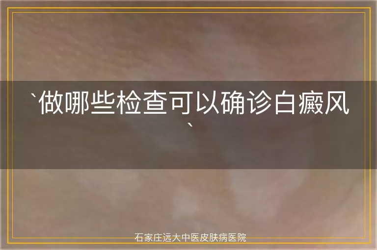 做哪些检查可以确诊白癜风