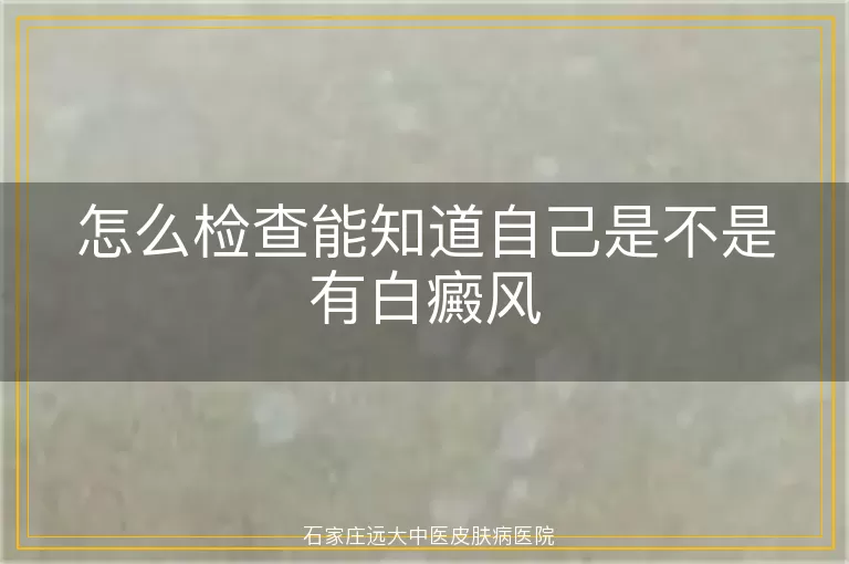 怎么检查能知道自己是不是有白癜风